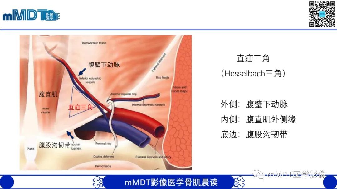 影像PPT - 【PPT】常见腹外疝的影像诊断（修正版）-10