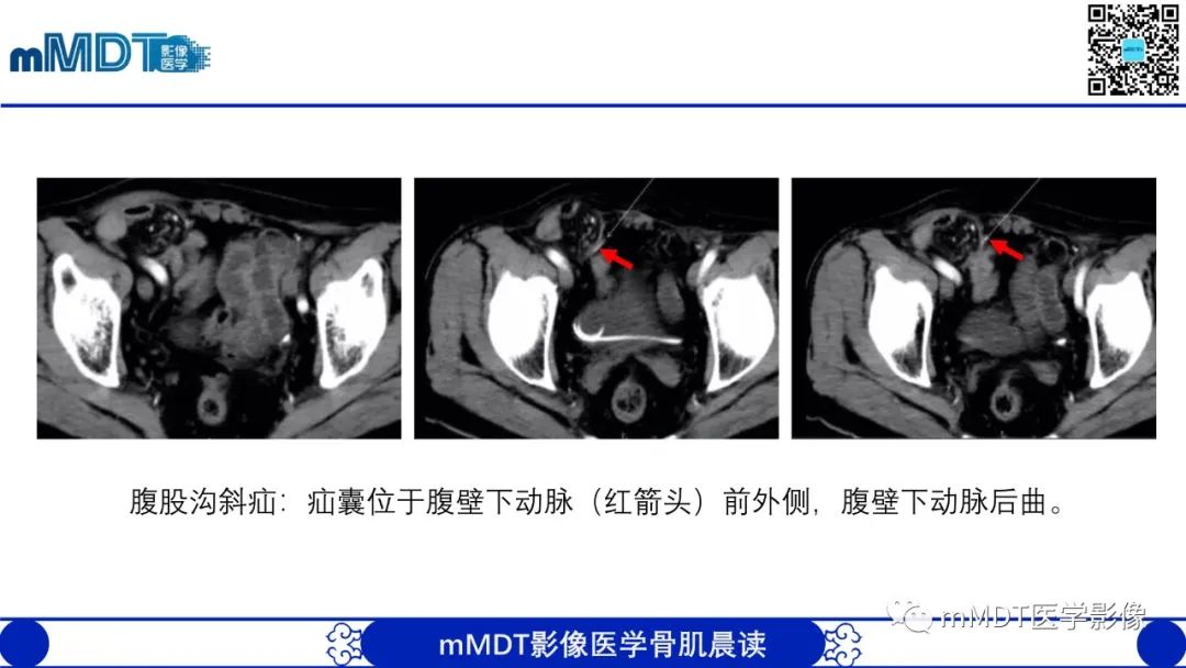 影像PPT - 【PPT】常见腹外疝的影像诊断（修正版）-7