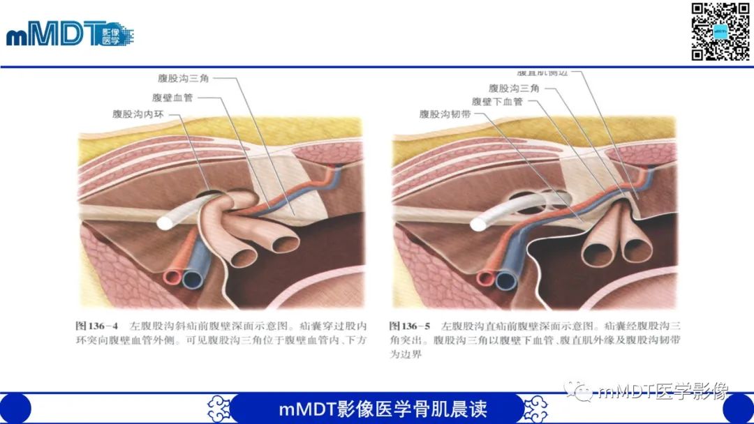 影像PPT - 【PPT】常见腹外疝的影像诊断（修正版）-6