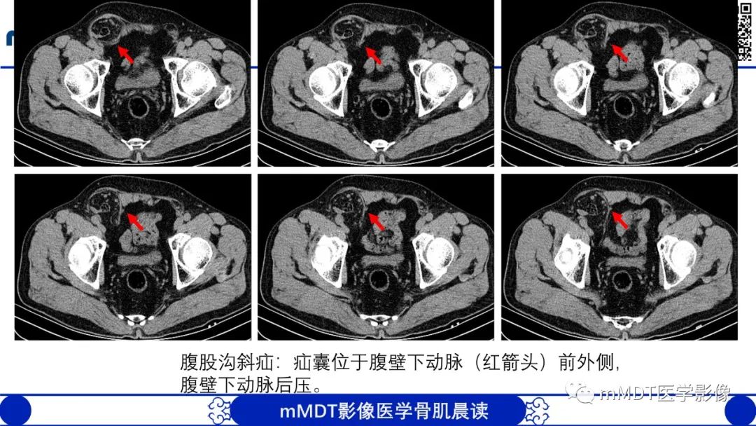 影像PPT - 【PPT】常见腹外疝的影像诊断（修正版）-8