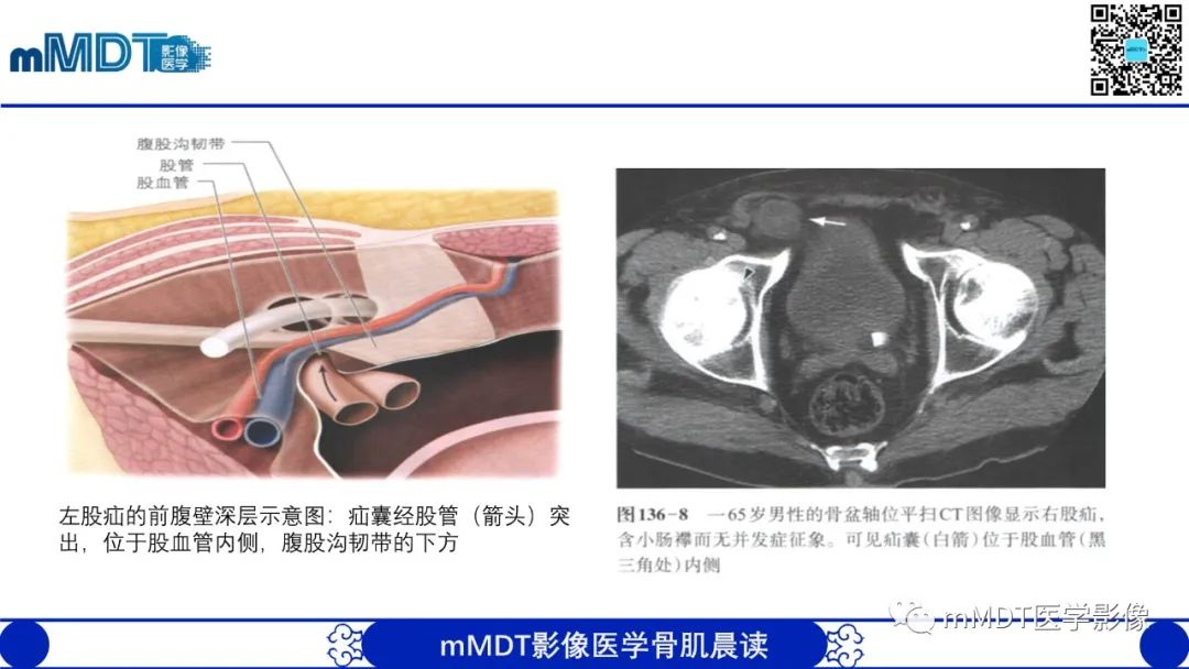 影像PPT - 【PPT】常见腹外疝的影像诊断（修正版）-14