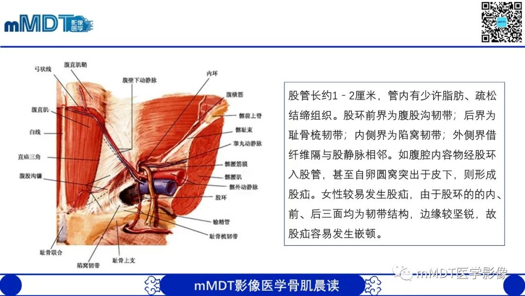 影像PPT - 【PPT】常见腹外疝的影像诊断（修正版）-13