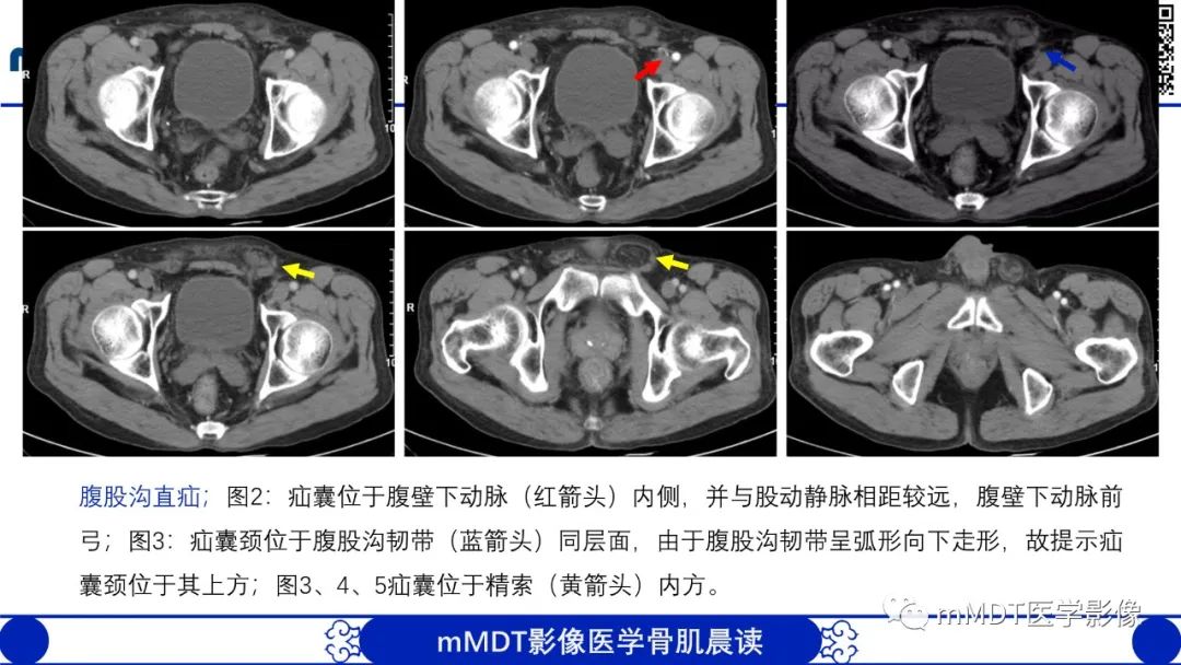 影像PPT - 【PPT】常见腹外疝的影像诊断（修正版）-11