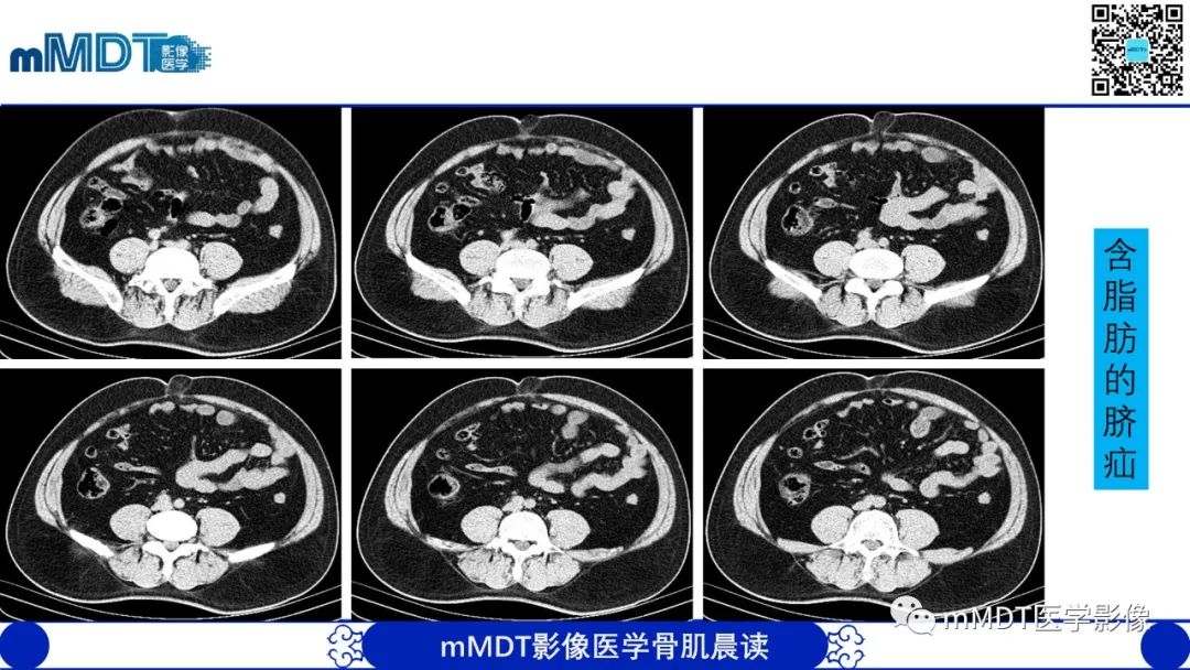 影像PPT - 【PPT】常见腹外疝的影像诊断（修正版）-19