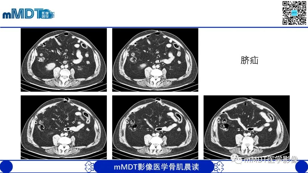 影像PPT - 【PPT】常见腹外疝的影像诊断（修正版）-20