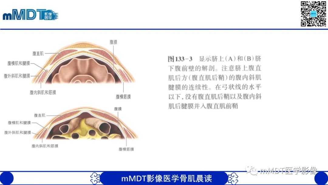 影像PPT - 【PPT】常见腹外疝的影像诊断（修正版）-21