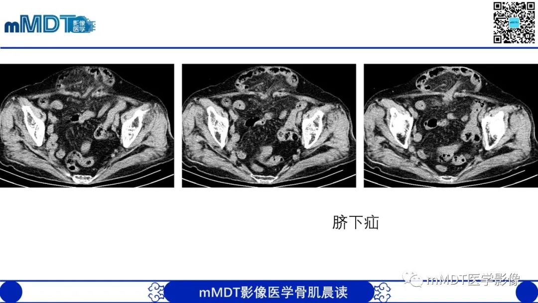 影像PPT - 【PPT】常见腹外疝的影像诊断（修正版）-22