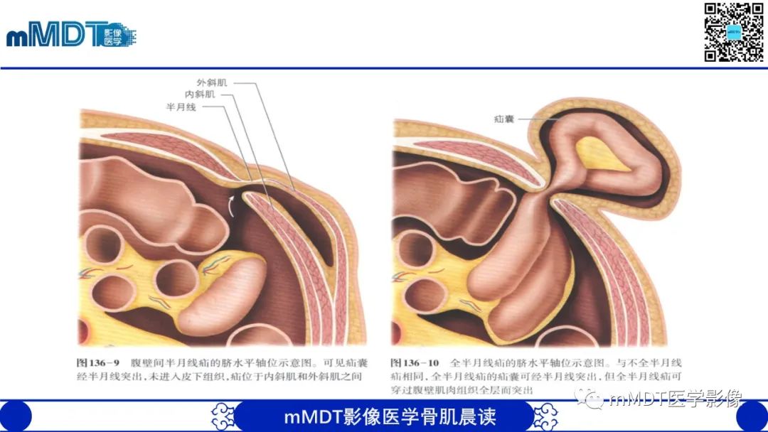 影像PPT - 【PPT】常见腹外疝的影像诊断（修正版）-23