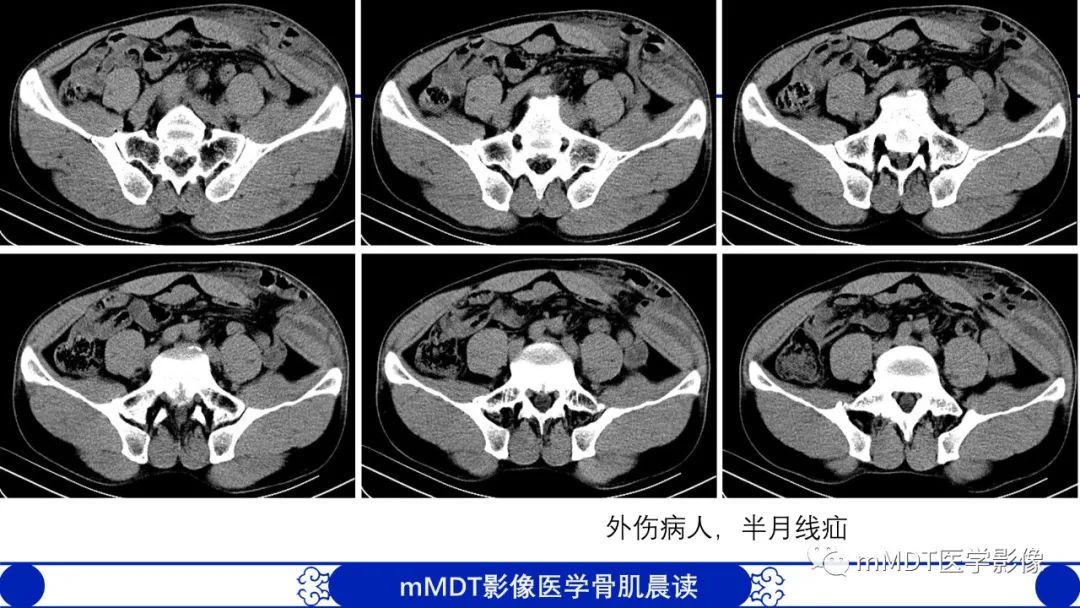 影像PPT - 【PPT】常见腹外疝的影像诊断（修正版）-24