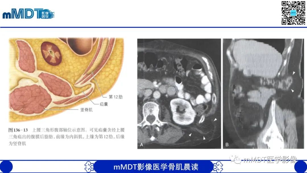 影像PPT - 【PPT】常见腹外疝的影像诊断（修正版）-27