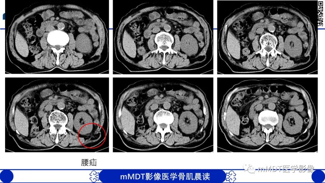 影像PPT - 【PPT】常见腹外疝的影像诊断（修正版）-28