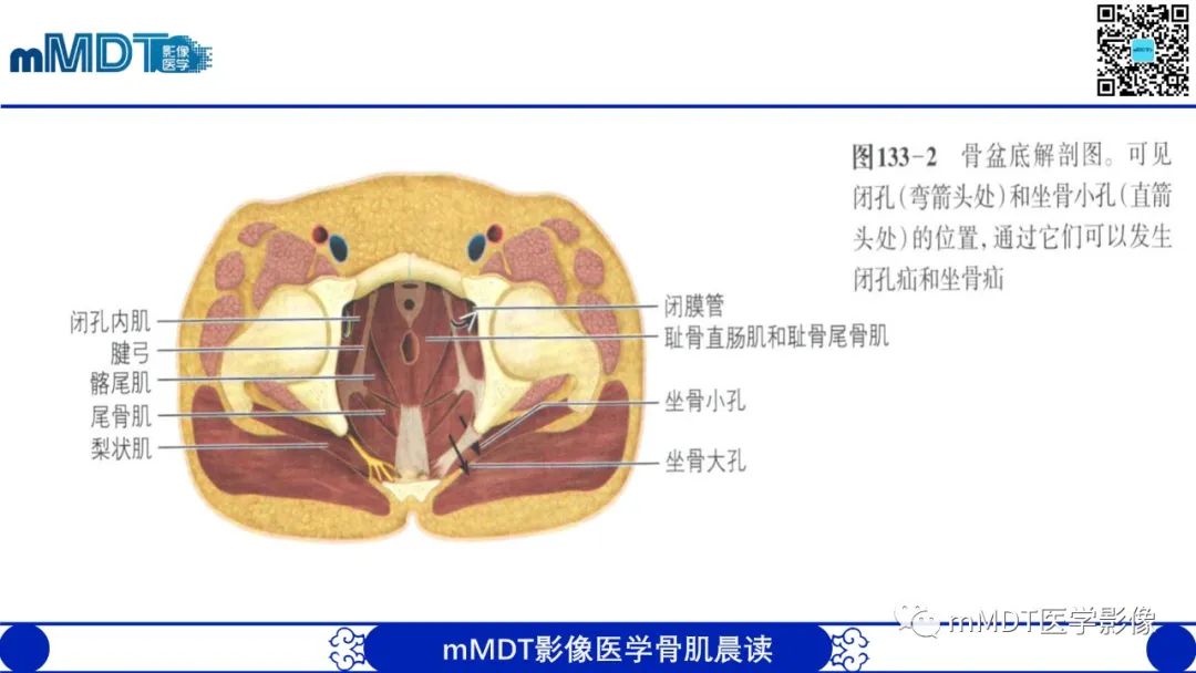 影像PPT - 【PPT】常见腹外疝的影像诊断（修正版）-29