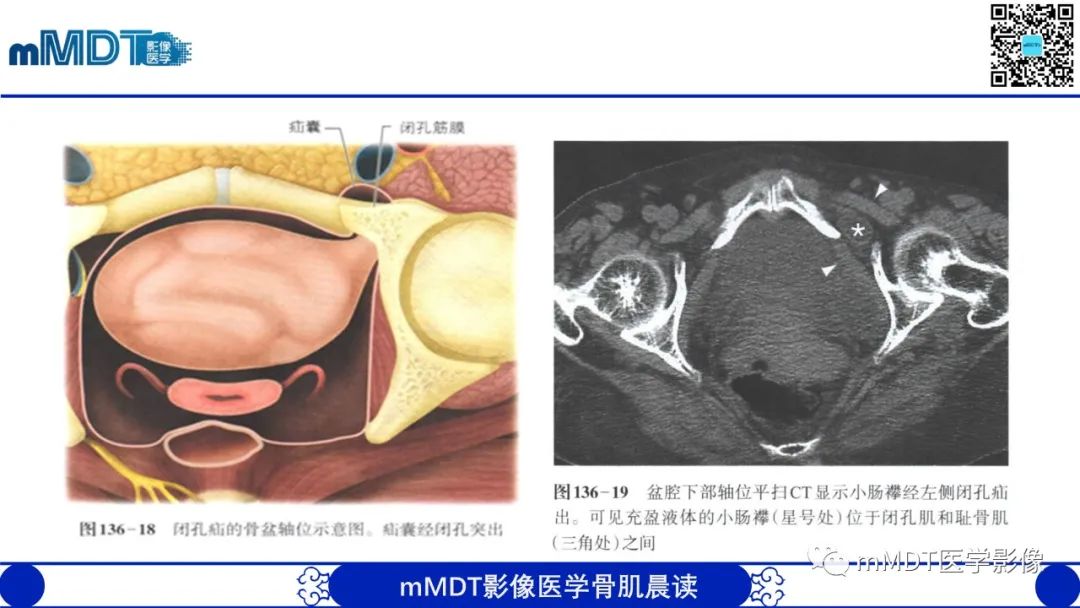 影像PPT - 【PPT】常见腹外疝的影像诊断（修正版）-30