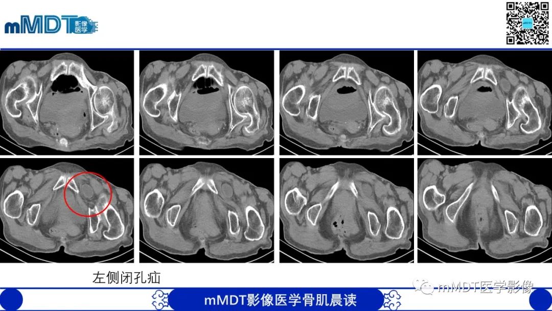 影像PPT - 【PPT】常见腹外疝的影像诊断（修正版）-31