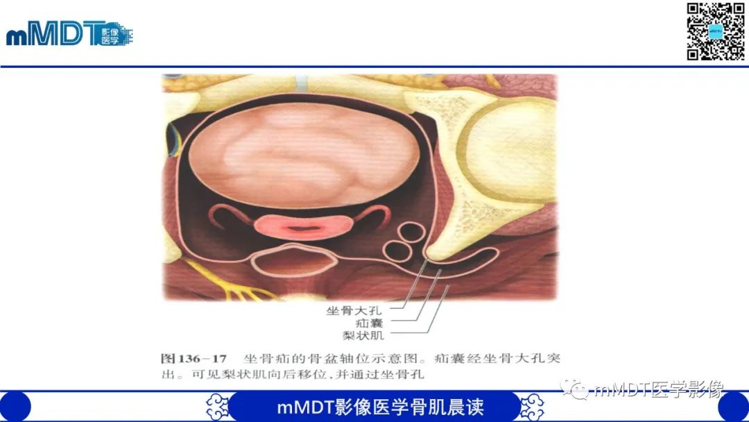 影像PPT - 【PPT】常见腹外疝的影像诊断（修正版）-32