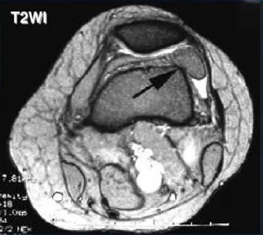 影像PPT - 膝关节滑膜病变分类及常见疾病-3 影像PPT - 膝关节滑膜病变分类及常见疾病-3