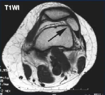 影像PPT - 膝关节滑膜病变分类及常见疾病-2 影像PPT - 膝关节滑膜病变分类及常见疾病-2