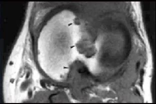 影像PPT - 膝关节滑膜病变分类及常见疾病-18 影像PPT - 膝关节滑膜病变分类及常见疾病-18