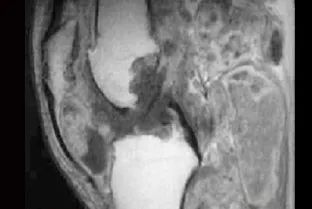 影像PPT - 膝关节滑膜病变分类及常见疾病-19 影像PPT - 膝关节滑膜病变分类及常见疾病-19