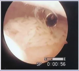 影像PPT - 膝关节滑膜病变分类及常见疾病-21 影像PPT - 膝关节滑膜病变分类及常见疾病-21