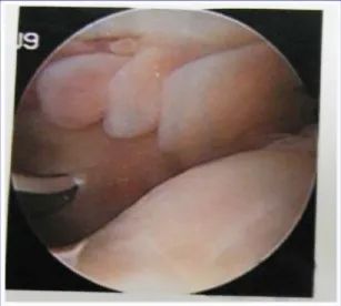 影像PPT - 膝关节滑膜病变分类及常见疾病-22 影像PPT - 膝关节滑膜病变分类及常见疾病-22