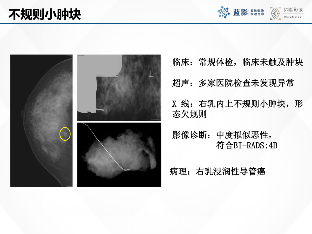 影像PPT - 【PPT】乳腺X线摄影在乳腺癌早筛早诊中的应用价值-6
