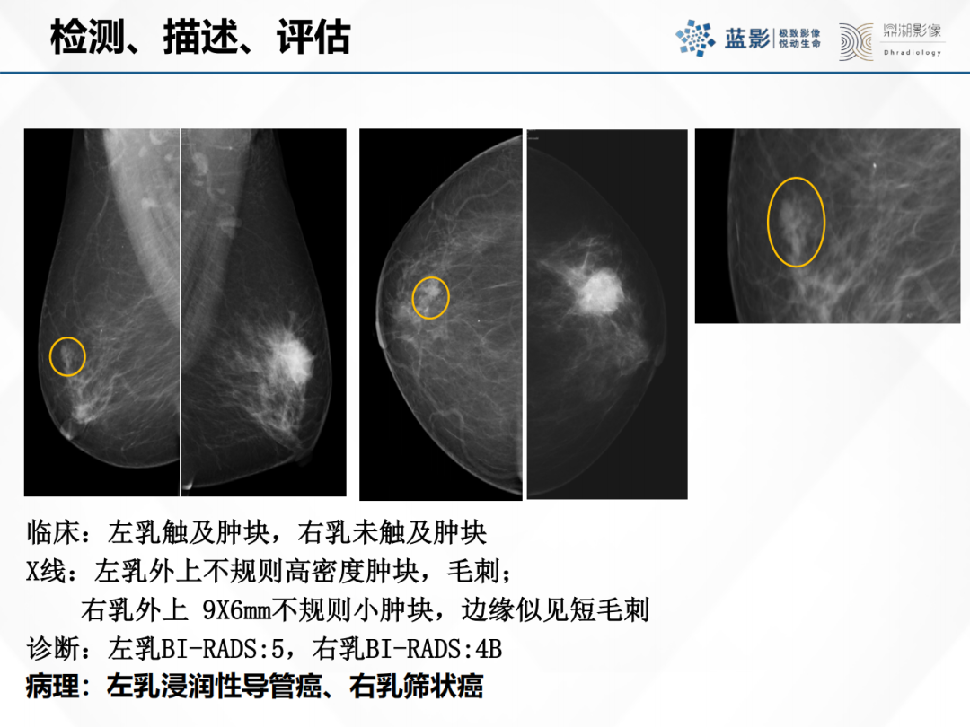 影像PPT - 【PPT】乳腺X线摄影在乳腺癌早筛早诊中的应用价值-9