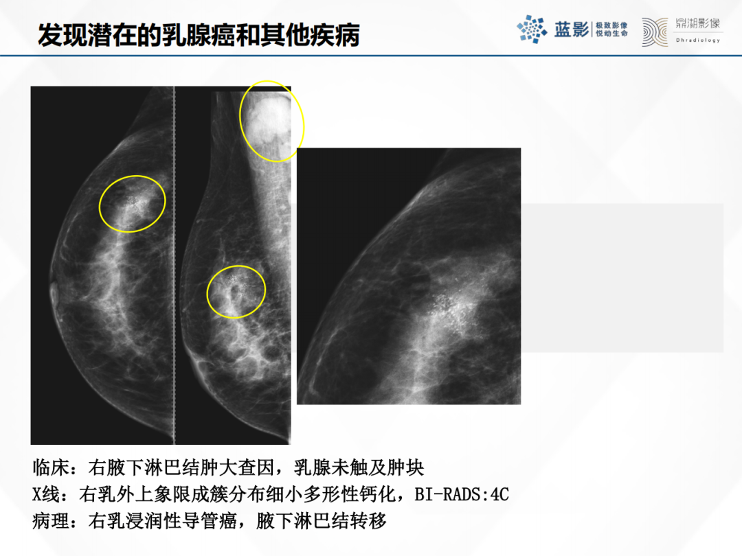影像PPT - 【PPT】乳腺X线摄影在乳腺癌早筛早诊中的应用价值-8