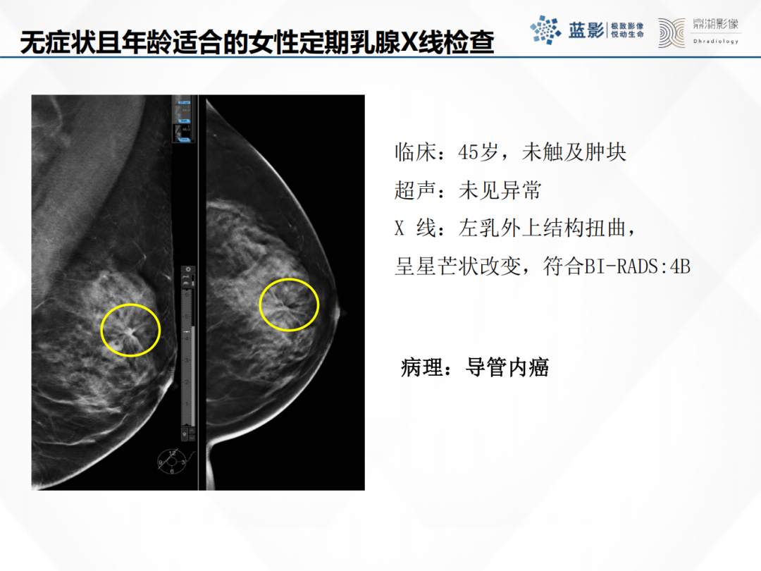 影像PPT - 【PPT】乳腺X线摄影在乳腺癌早筛早诊中的应用价值-11