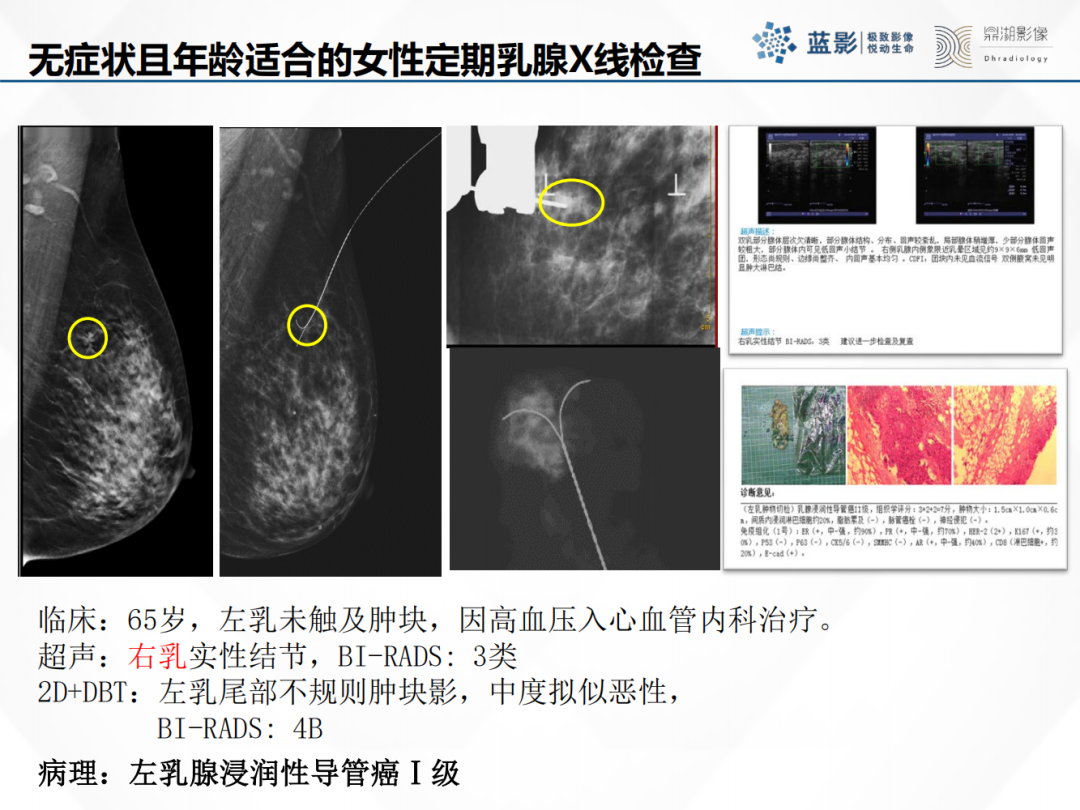 影像PPT - 【PPT】乳腺X线摄影在乳腺癌早筛早诊中的应用价值-10