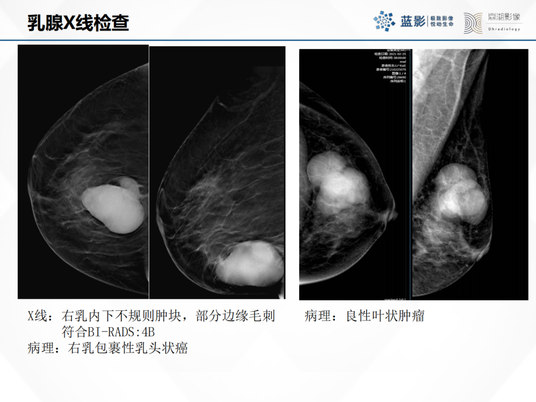 影像PPT - 【PPT】乳腺X线摄影在乳腺癌早筛早诊中的应用价值-13