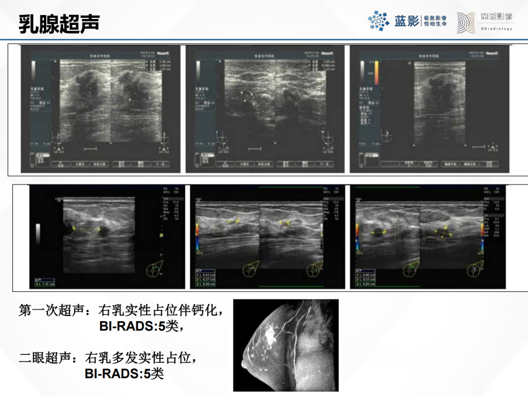 影像PPT - 【PPT】乳腺X线摄影在乳腺癌早筛早诊中的应用价值-14