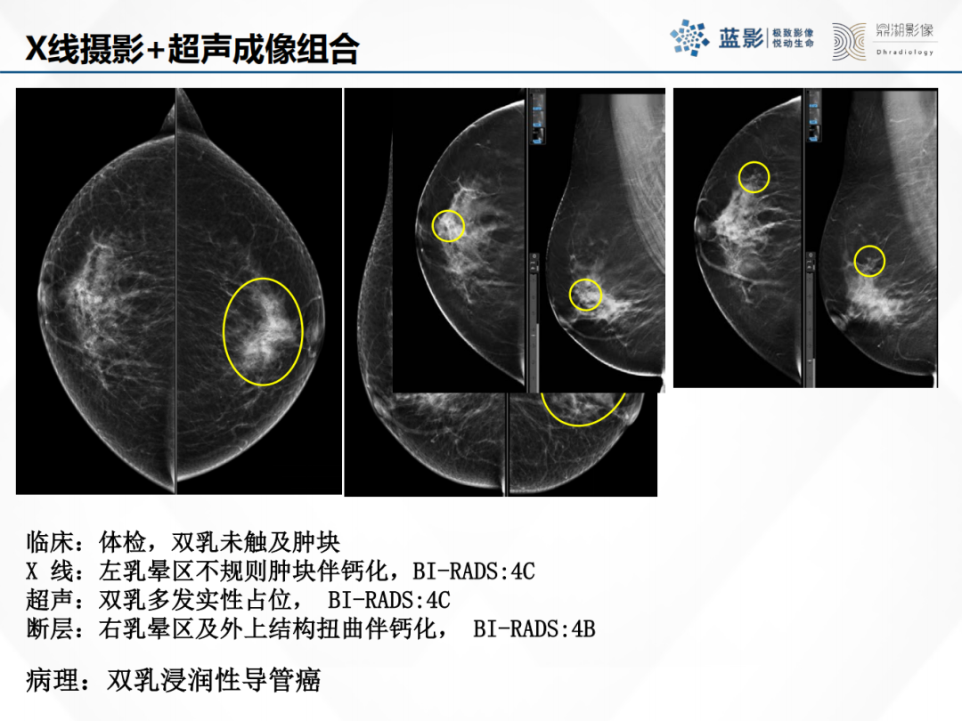 影像PPT - 【PPT】乳腺X线摄影在乳腺癌早筛早诊中的应用价值-15