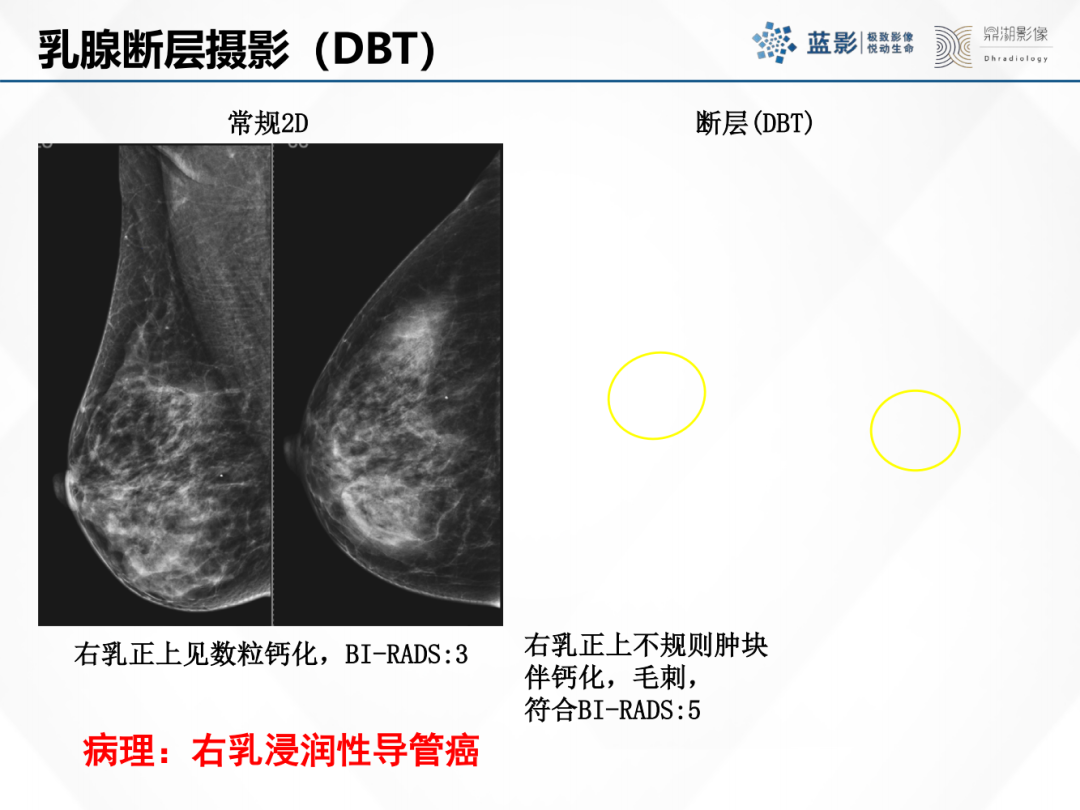 影像PPT - 【PPT】乳腺X线摄影在乳腺癌早筛早诊中的应用价值-16