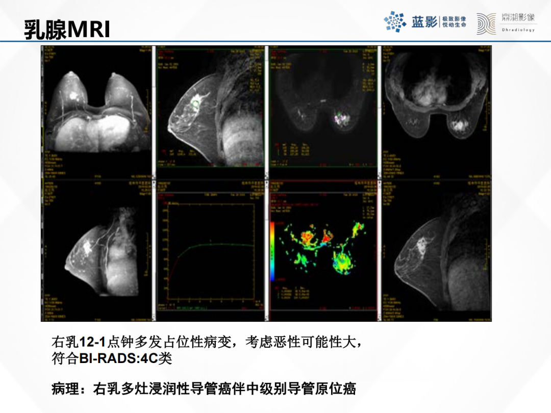影像PPT - 【PPT】乳腺X线摄影在乳腺癌早筛早诊中的应用价值-17