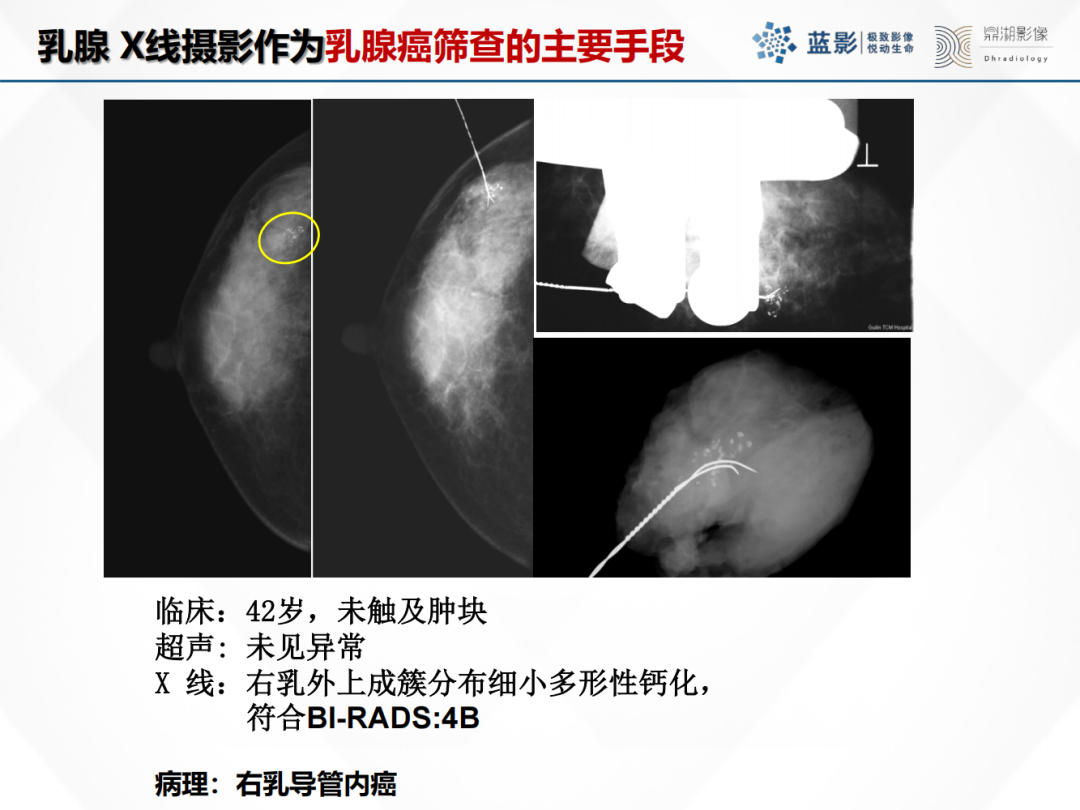影像PPT - 【PPT】乳腺X线摄影在乳腺癌早筛早诊中的应用价值-21
