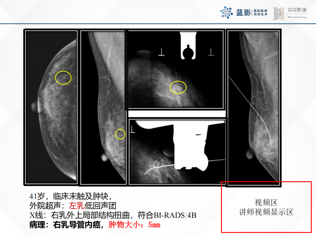 影像PPT - 【PPT】乳腺X线摄影在乳腺癌早筛早诊中的应用价值-22
