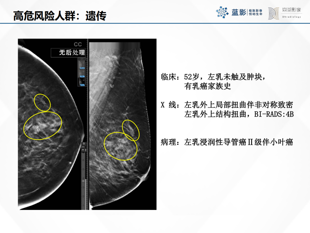 影像PPT - 【PPT】乳腺X线摄影在乳腺癌早筛早诊中的应用价值-24