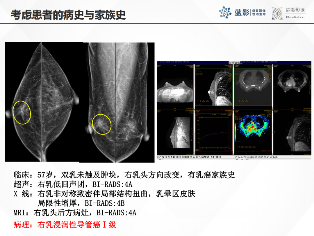 影像PPT - 【PPT】乳腺X线摄影在乳腺癌早筛早诊中的应用价值-25