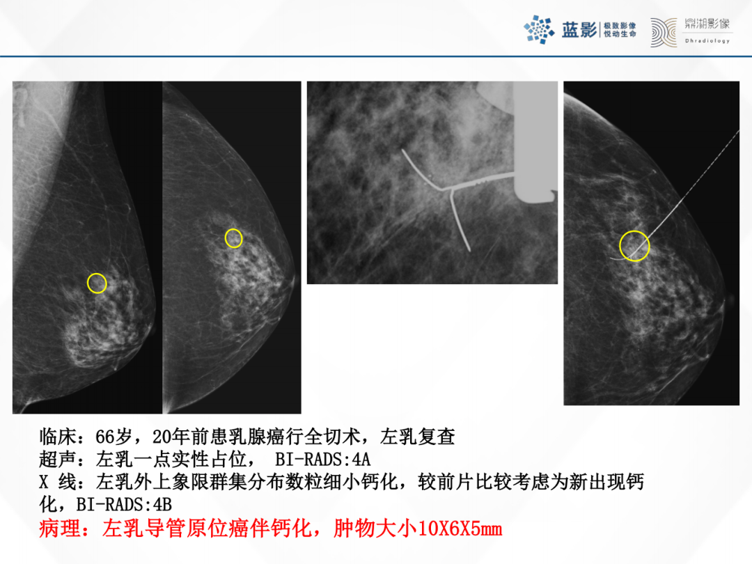 影像PPT - 【PPT】乳腺X线摄影在乳腺癌早筛早诊中的应用价值-26