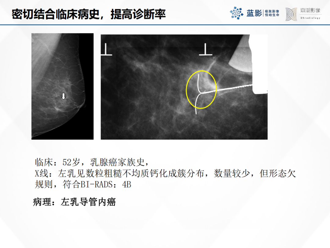 影像PPT - 【PPT】乳腺X线摄影在乳腺癌早筛早诊中的应用价值-28