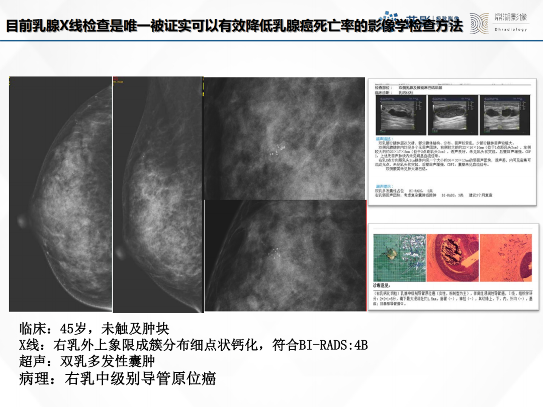 影像PPT - 【PPT】乳腺X线摄影在乳腺癌早筛早诊中的应用价值-31
