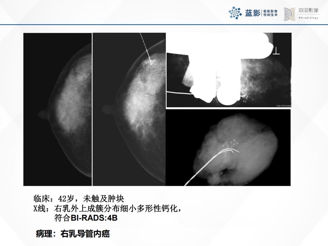 影像PPT - 【PPT】乳腺X线摄影在乳腺癌早筛早诊中的应用价值-32