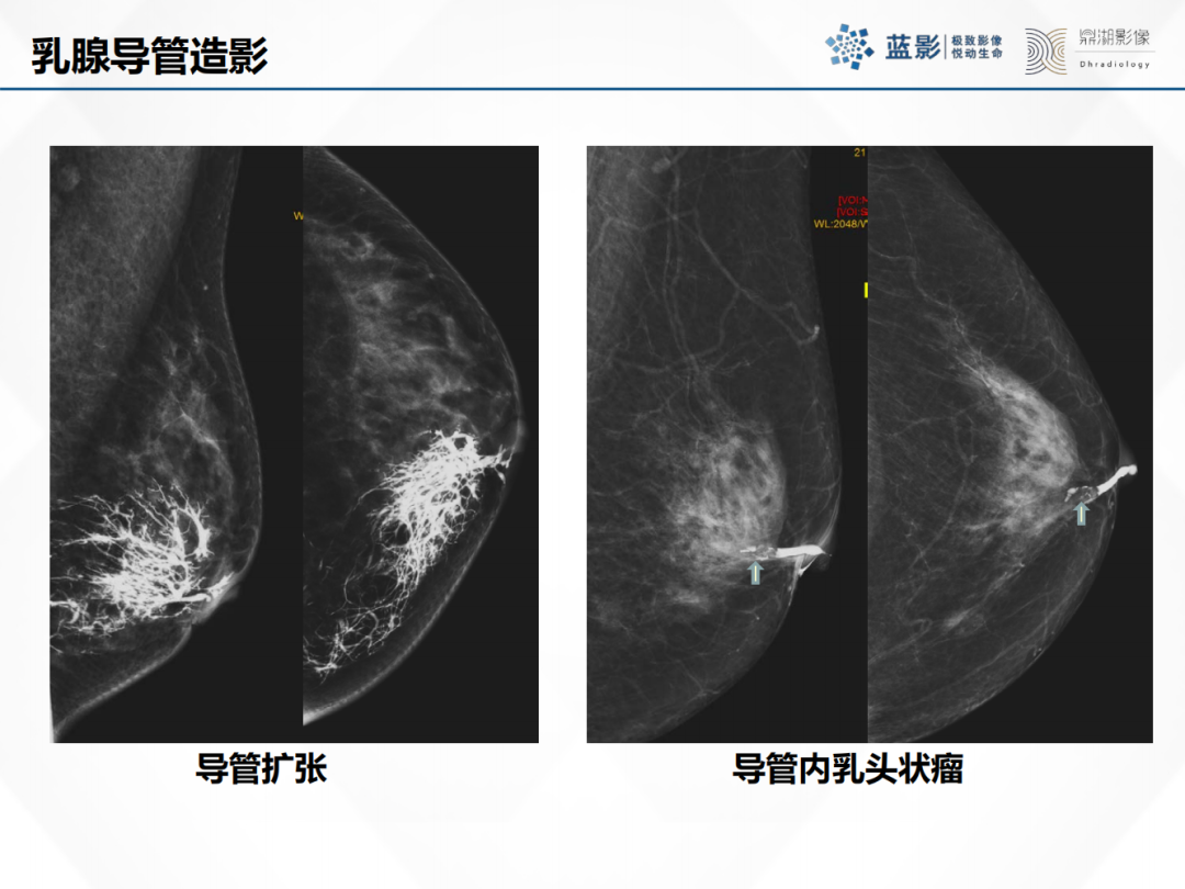 影像PPT - 【PPT】乳腺X线摄影在乳腺癌早筛早诊中的应用价值-37