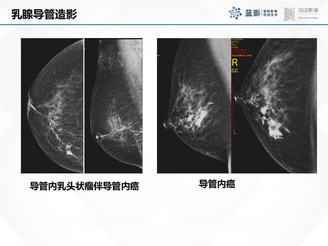 影像PPT - 【PPT】乳腺X线摄影在乳腺癌早筛早诊中的应用价值-38