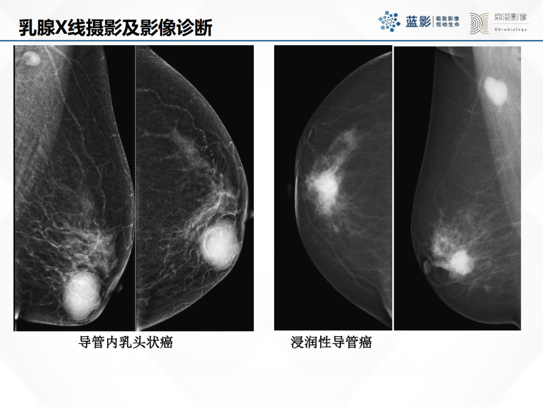 影像PPT - 【PPT】乳腺X线摄影在乳腺癌早筛早诊中的应用价值-36