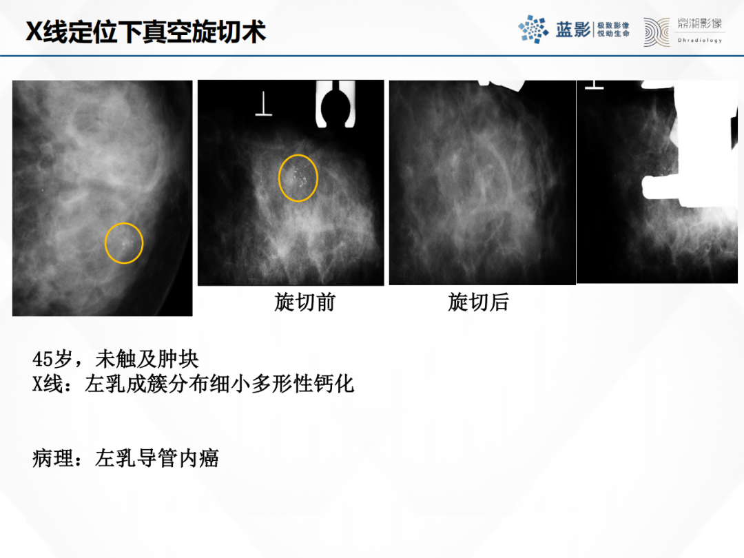 影像PPT - 【PPT】乳腺X线摄影在乳腺癌早筛早诊中的应用价值-41
