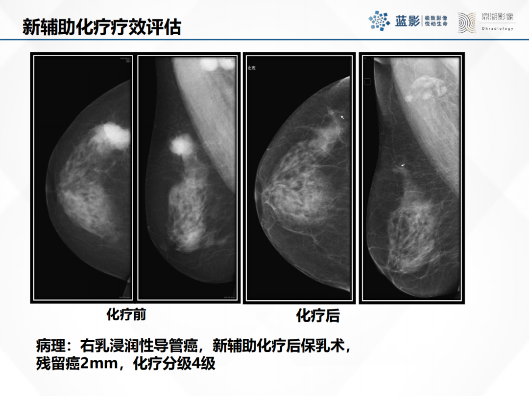 影像PPT - 【PPT】乳腺X线摄影在乳腺癌早筛早诊中的应用价值-39
