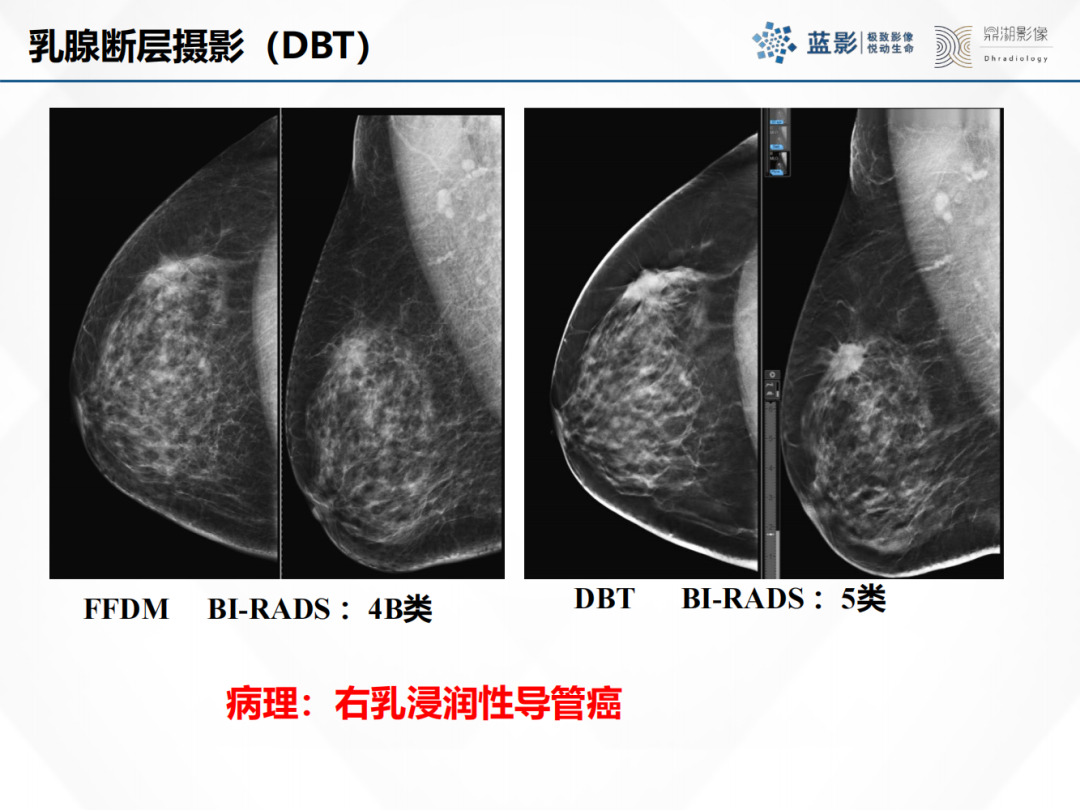 影像PPT - 【PPT】乳腺X线摄影在乳腺癌早筛早诊中的应用价值-42