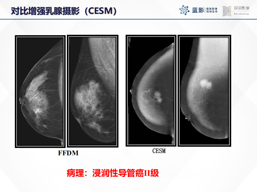影像PPT - 【PPT】乳腺X线摄影在乳腺癌早筛早诊中的应用价值-43